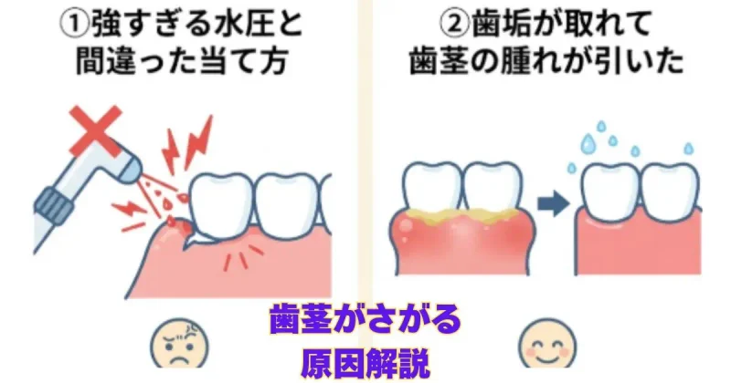 ジェットウォシャーで歯茎がさがる原因解説